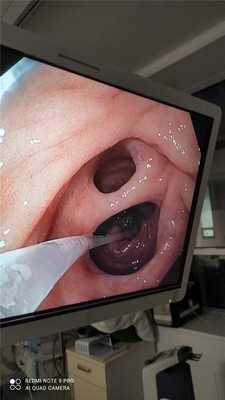 Двойной привратник Double pylorus. Атлас эндоскопических изображений endoatlas