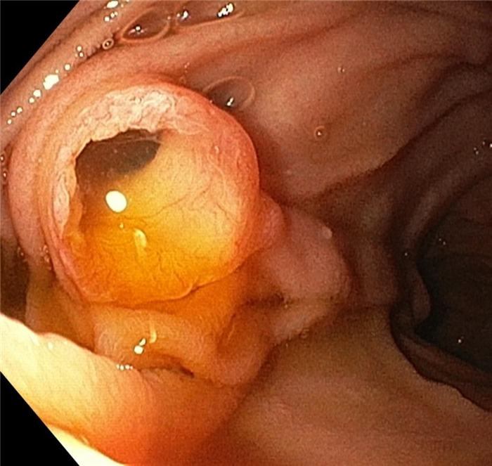 Муцинозная внутрипротоковая цистаденокарцинома поджелудочной железы. Атлас эндоскопических изображений endoatlas