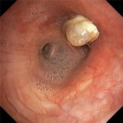 Аспергиллез верхнедолевого бронха слева. Атлас эндоскопических изображений endoatlas