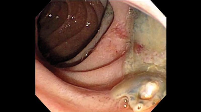 ЭРХПГ. Печеночная двуустка (fasciola hepatica). Атлас эндоскопических изображений endoatlas
