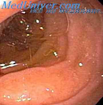 эндоскопия