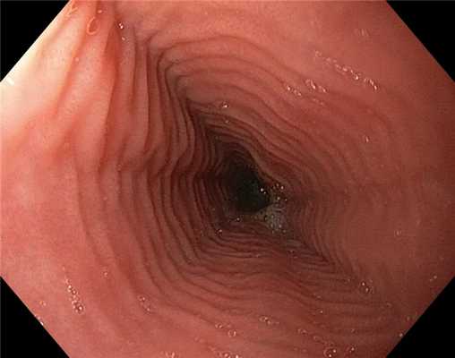 Эозинофильный эзофагит. E - 0 R - 2 E - 1 F - 0 S - 0 по EREFS критериям (по Ikuo Yirano 2013г. ). . Атлас эндоскопических изображений endoatlas