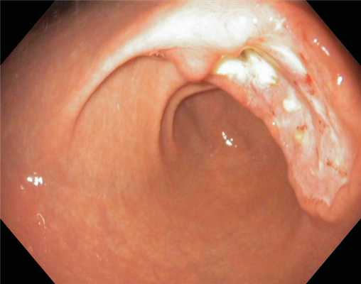 MALT-лимфомы с трансформацией в диффузную крупноклеточную В-клеточную лимфому. Актиномикоз желудка.. Атлас эндоскопических изображений endoatlas