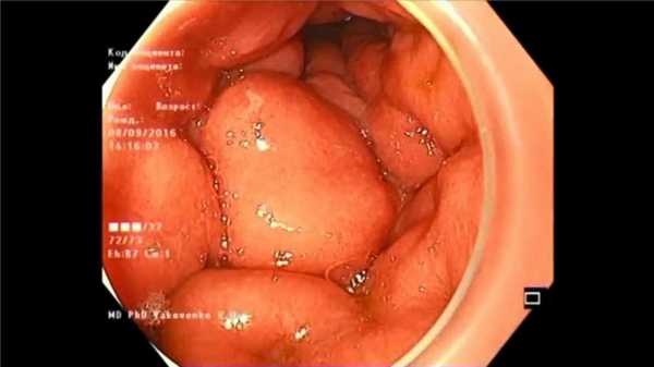 Linitis plastica Пластический линит. Атлас эндоскопических изображений endoatlas