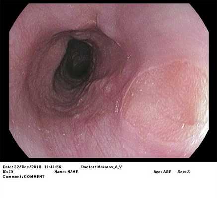 Гетеротопия (эктопия) желудочного эпителия в пищевод. Атлас эндоскопических изображений endoatlas