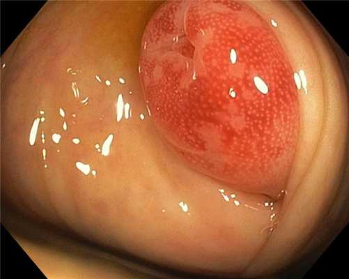 Устье аппендикса. Аппендикулярный инфильтрат.jpg. Атлас эндоскопических изображений endoatlas