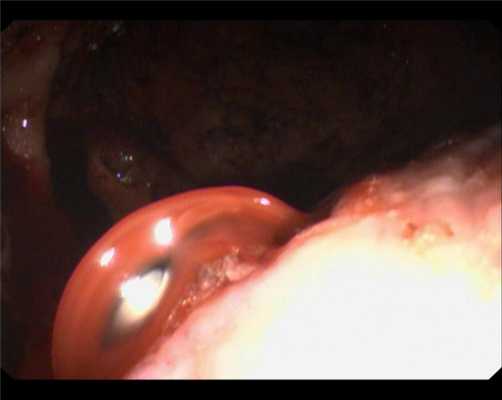 Forrest 1А. Атлас эндоскопических изображений endoatlas