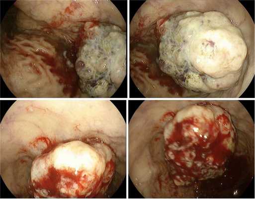 Аденокарцинома (G2) в/3 тела желудка тип-1. Атлас эндоскопических изображений endoatlas