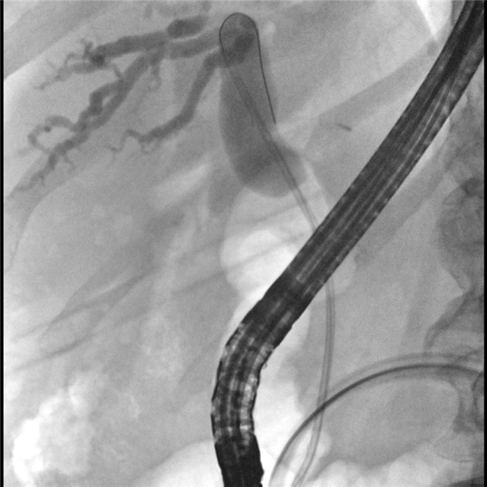 Холангиокарцинома, Бисмут I. Атлас эндоскопических изображений endoatlas