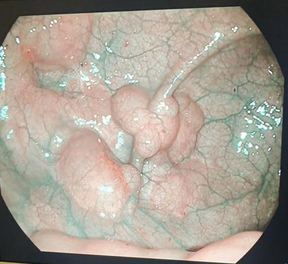 Пневматоз Толстой кишки. Атлас эндоскопических изображений endoatlas