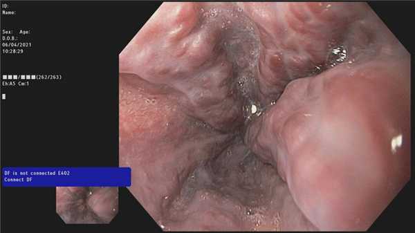 Варикозное расширение вен пищевода III ст.. Атлас эндоскопических изображений endoatlas