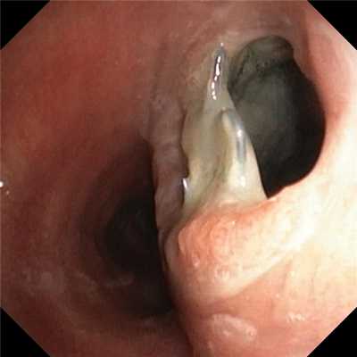 Трахеопищеводный свищ. Атлас эндоскопических изображений endoatlas