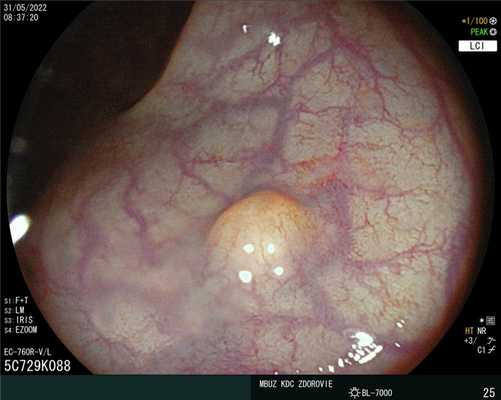 Неэпителиальное образование прямой кишки. Атлас эндоскопических изображений endoatlas