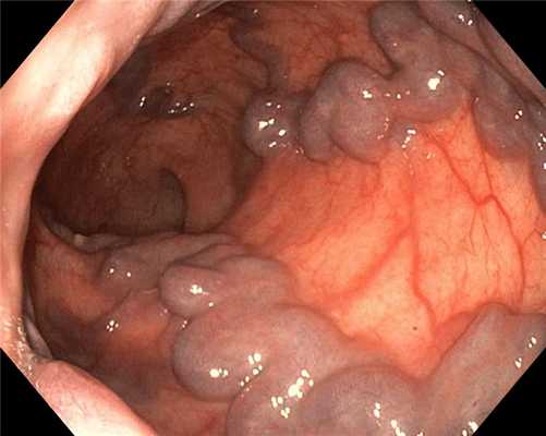 ВРВП прямой кишки. Атлас эндоскопических изображений endoatlas