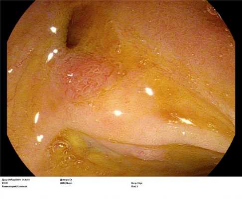 Супрапапиллярный свищ. Атлас эндоскопических изображений endoatlas