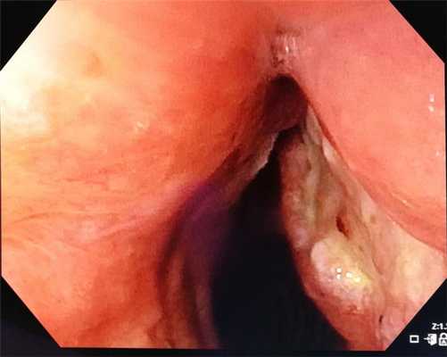 опухоль левой голосовой связки с изъязвлением . Атлас эндоскопических изображений endoatlas