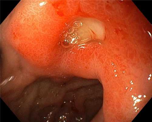 Хроническая язва луковицы 12-перстной кишки. Атлас эндоскопических изображений endoatlas