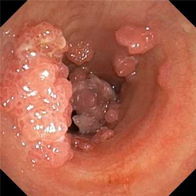 Папилломатоз трахеи. Атлас эндоскопических изображений endoatlas
