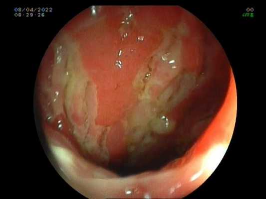 Болезнь Крона. . Атлас эндоскопических изображений endoatlas