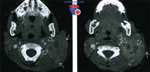 КТ, МРТ, УЗИ при нагноении лимфатических узлов шеи