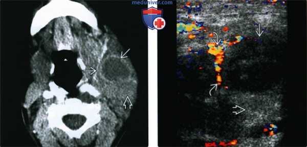 КТ, МРТ, УЗИ при нагноении лимфатических узлов шеи
