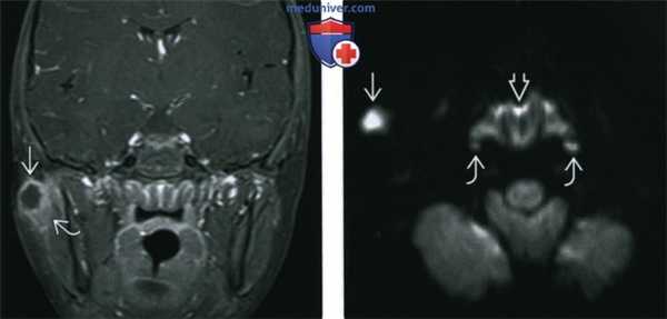 КТ, МРТ, УЗИ при нагноении лимфатических узлов шеи
