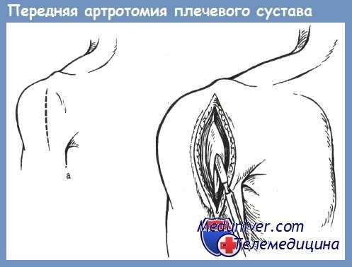 передняя артротомия плечевого сустава