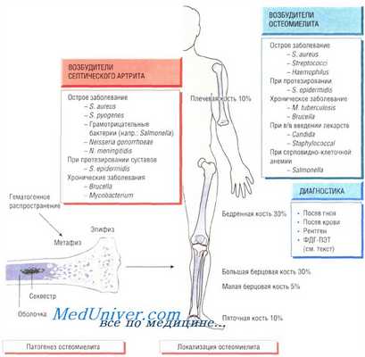 инфекции костей и суставов