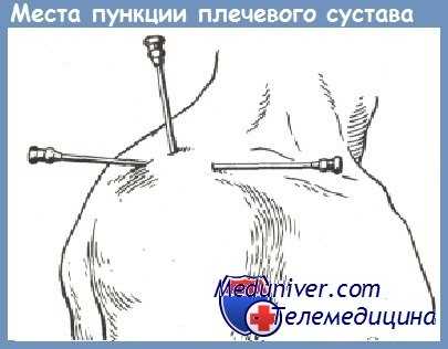 точки пункции плечевого сустава