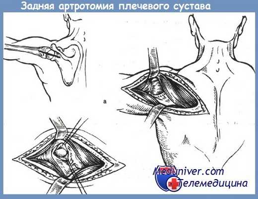 задняя артротомия плечевого сустава