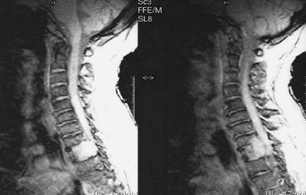 Метастазы на снимках МРТ шеи