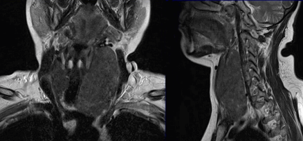 Онкологический процесс на томограммах щитовидной железы