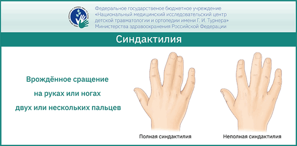 Синдактилия у детей - комплексный подход к лечению