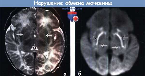 Нарушение обмена мочевины на МРТ головного мозга