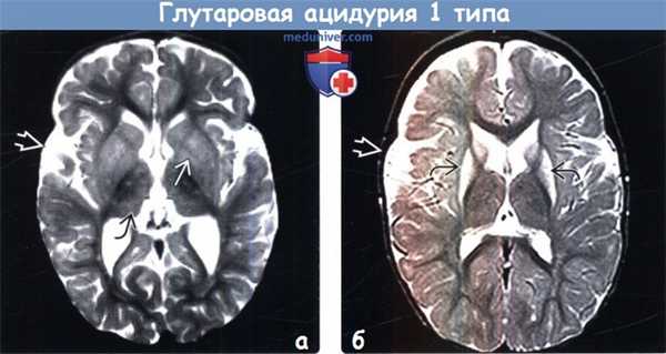 Глутаровая ацидурия 1 типа на МРТ головного мозга