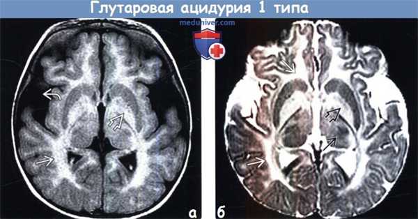 Глутаровая ацидурия 1 типа на МРТ головного мозга