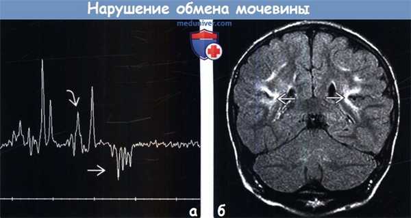 Нарушение обмена мочевины на МРТ головного мозга