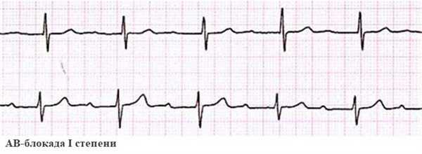 АВ-блокада I степени