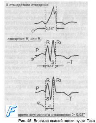 Нарушение проводимости. Нарушение внутрижелудочковой проводимости.