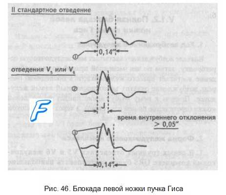 Нарушение проводимости. Нарушение внутрижелудочковой проводимости.