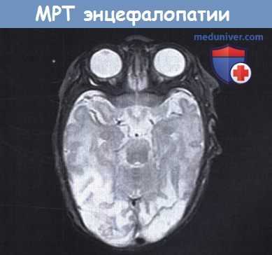 МРТ энцефалопатии