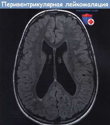 МРТ при перивентрикулярной лейкомаляции