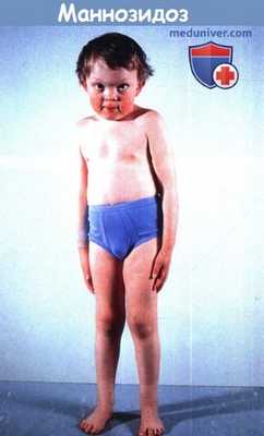 Маннозидоз