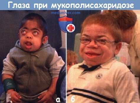 Глаза при мукополисахаридозе
