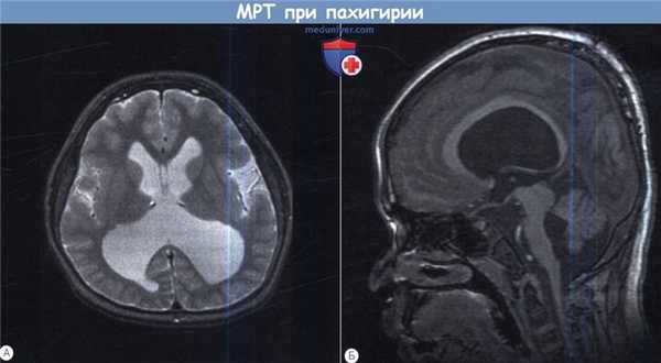 МРТ при пахигирии