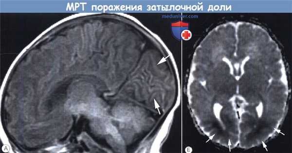 МРТ поражения затылочной доли