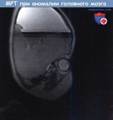 МРТ при аномалии головного мозга