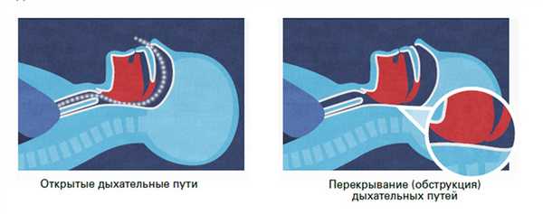 Обструкция дыхательных путей при апноэ сна