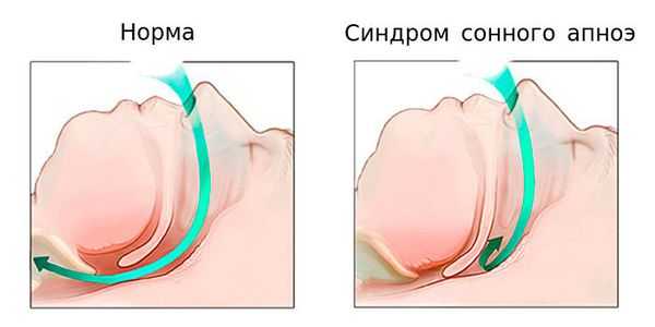 Нормальное поступление воздуха и синдром сонного апноэ