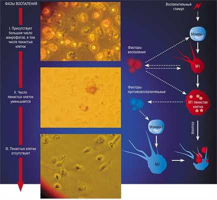 Макрофаги образуются из клеток-предшественников (моноцитов) уже в самые первые часы воспаления, вызванного определенным стимулом (например, бактерией). Макрофаги М1 и пенистые клетки начинают продуцировать провоспалительные факторы и кислородные метаболиты и активно захватывать «чужеродные» молекулы. На 1—3-е сутки воспалительного процесса пенистые клетки начинают секретировать противовоспалительные факторы, которые активируют липидные сенсоры моноцитов, мигрирующих из русла крови в очаг воспаления. Так образуются макрофаги М2. Сами пенистые клетки погибают в ходе запрограммированной клеточной смерти (апоптоза) и поглощаются макрофагами М2. Это сигнал о завершении воспаления (5-е сутки). На фото – фазово-контрастная микроскопия клеток, полученных из перитонеальной полости мышей при воспалении